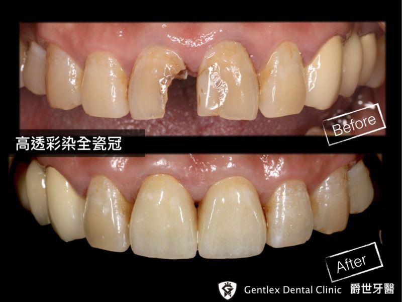 高透彩染全瓷冠