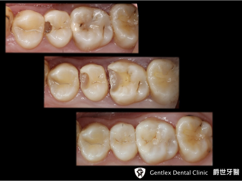 數位3D齒雕瓷塊修復