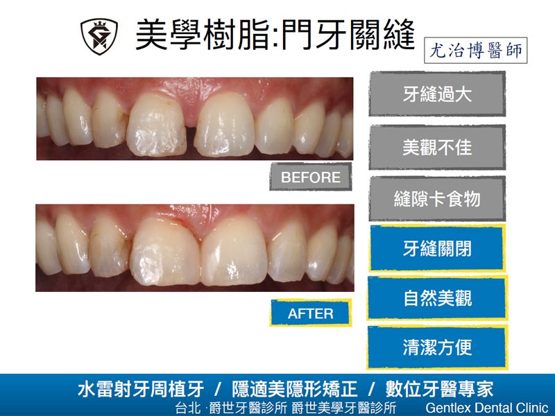 美學樹脂:門牙關縫