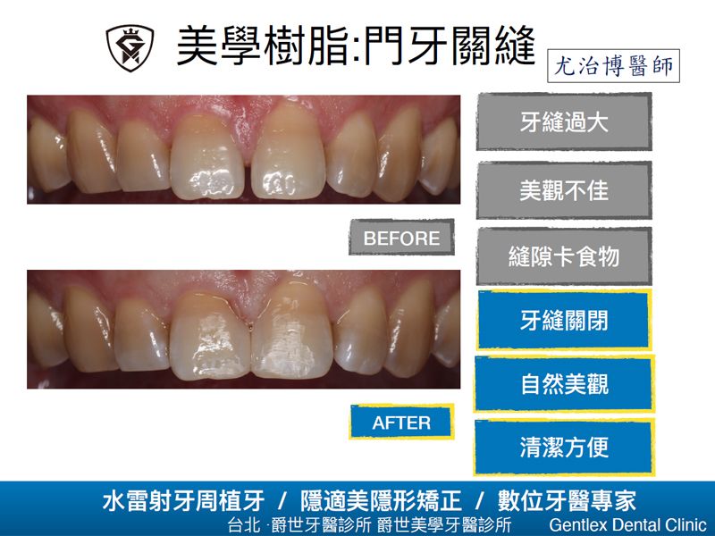 美學樹脂:門牙關縫