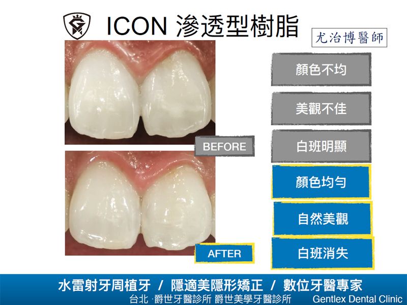 ICON 滲透型樹脂