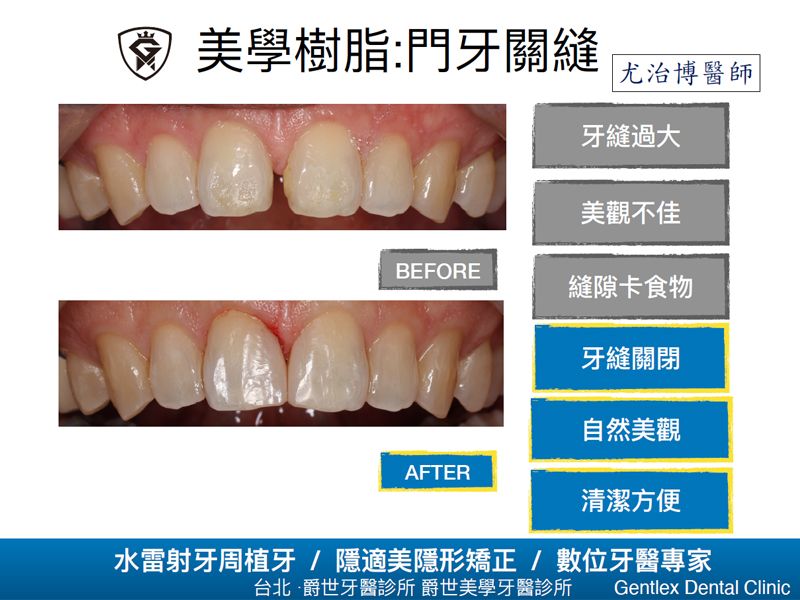 美學樹脂:門牙關縫