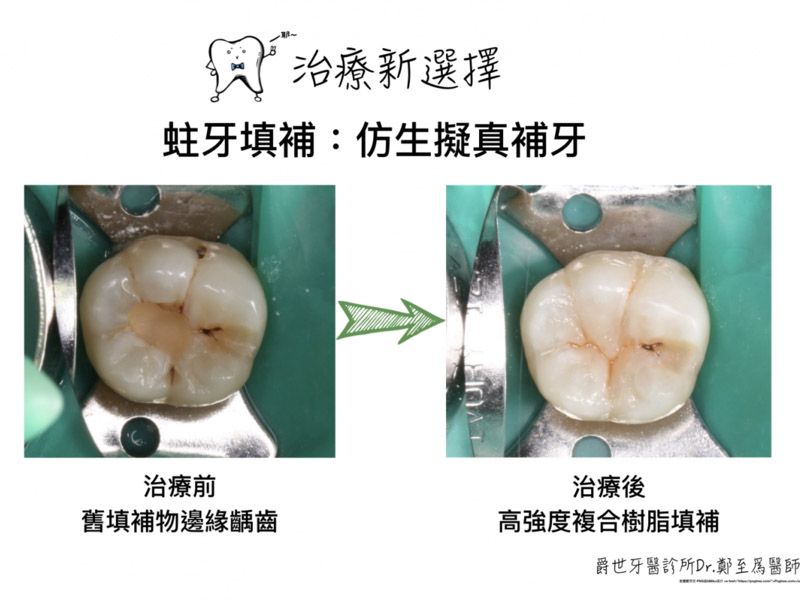 美學樹脂擬真補牙