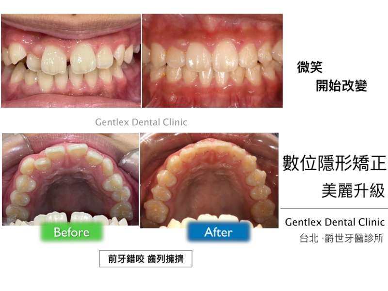 前牙錯咬 齒列擁擠