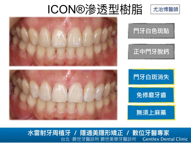 滲透型樹脂修補