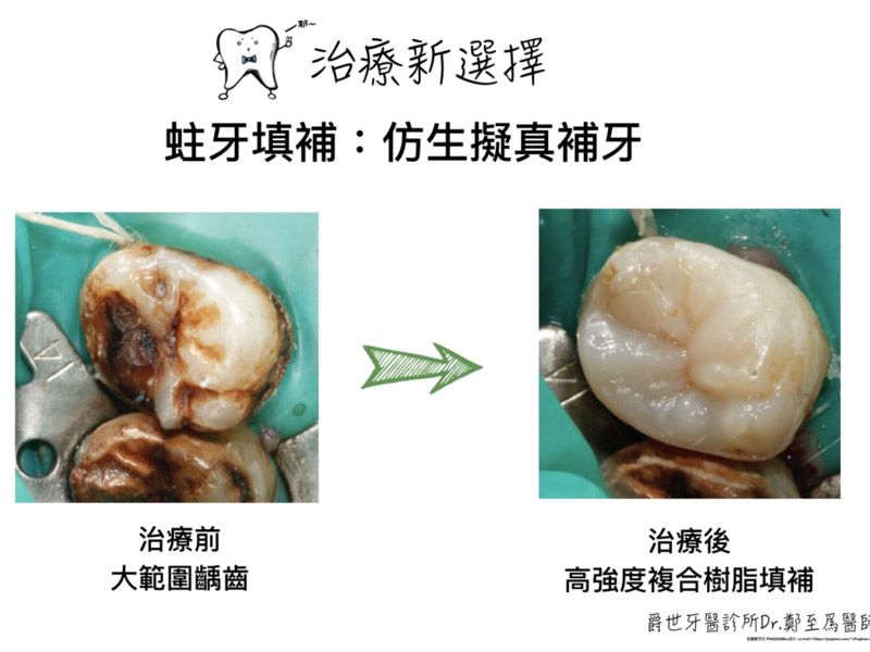 美學樹脂擬真補牙