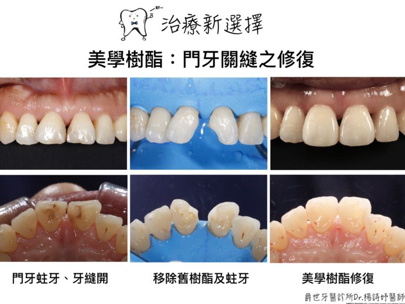 美學樹脂修復前牙