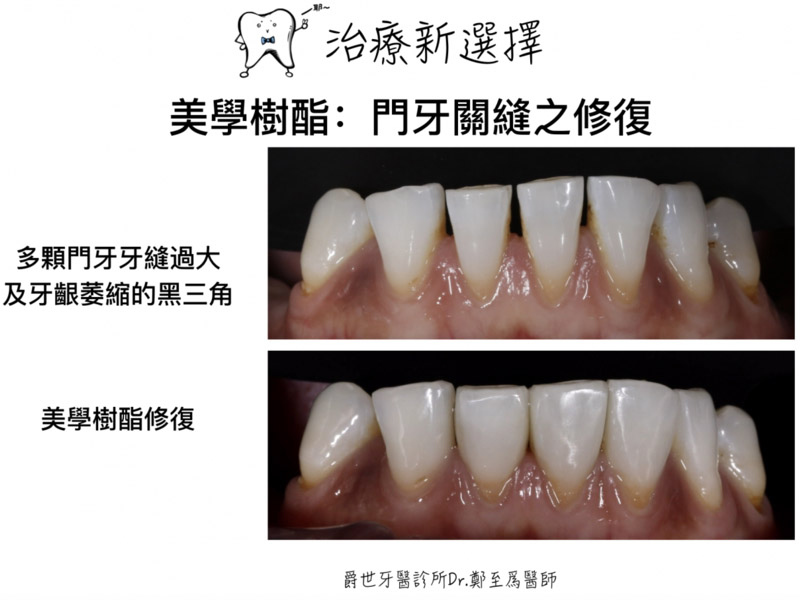 前牙美學樹脂復形