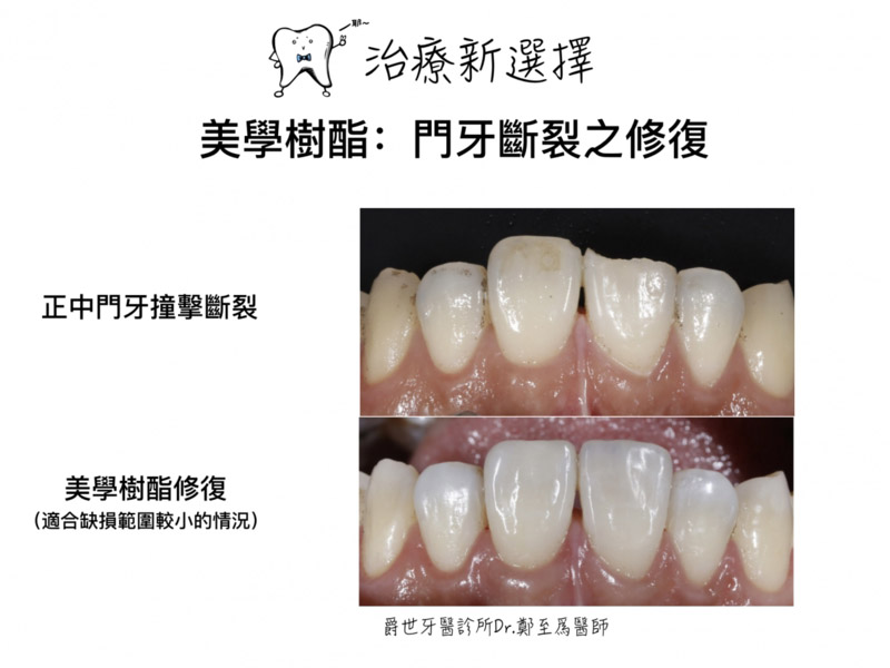 門牙斷裂 美學樹脂重建