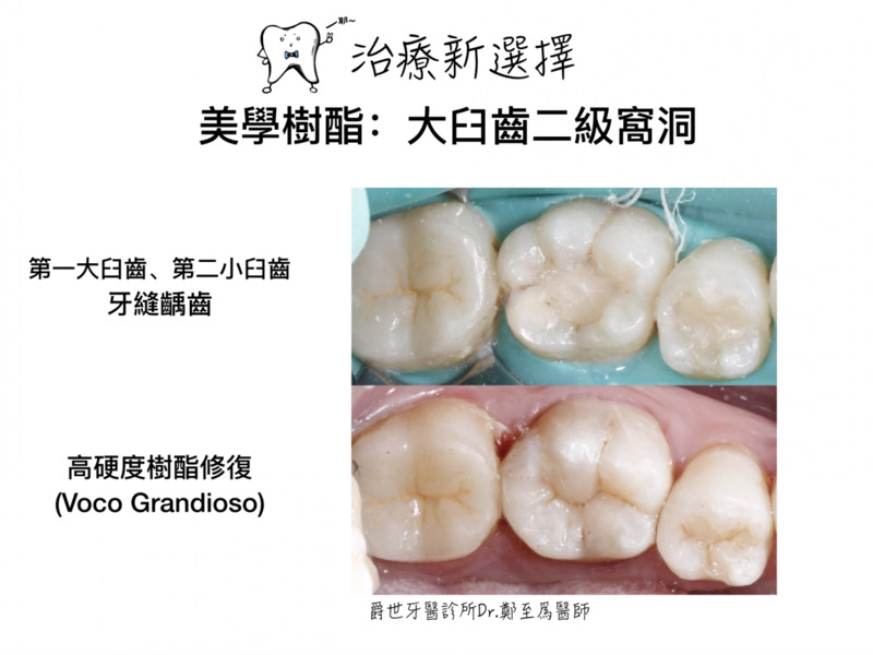 美學樹脂大臼齒修復