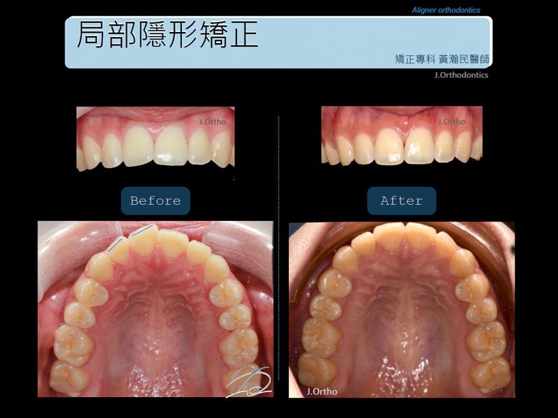 局部隱形矯正