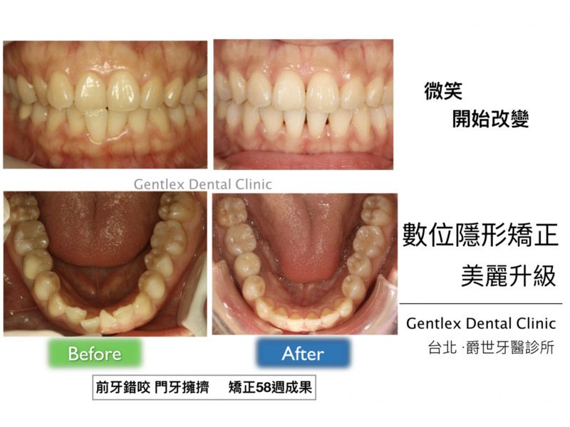 前牙錯咬 門牙擁擠