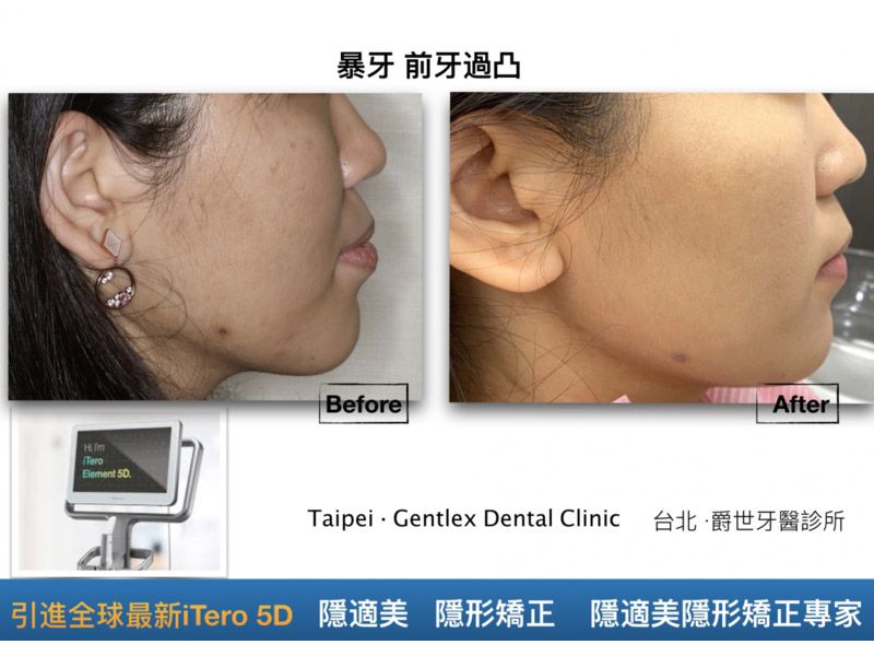拔牙改善暴牙嘴凸