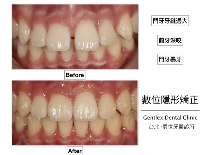 門牙牙縫過大 暴牙