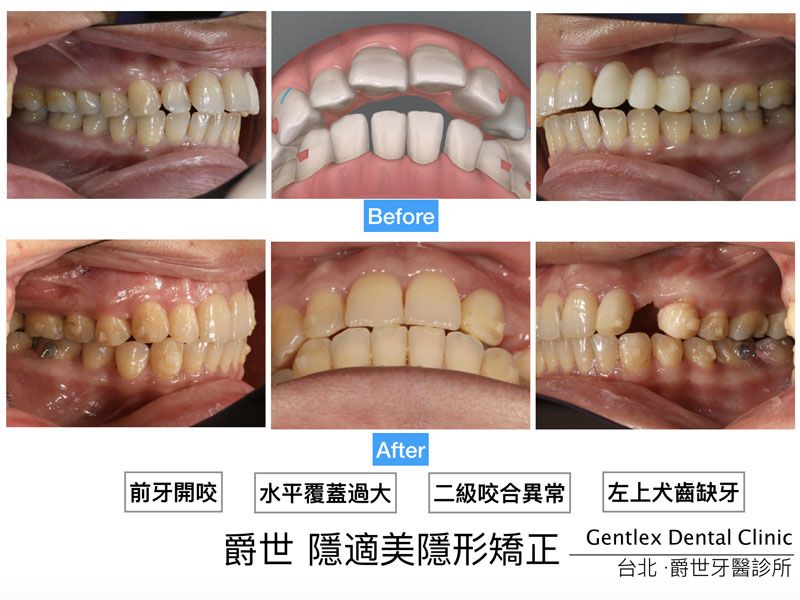 前牙開咬 暴牙矯正