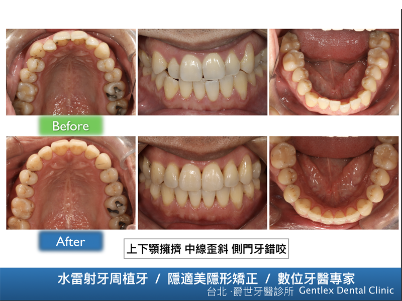 前牙錯咬 咬合不正