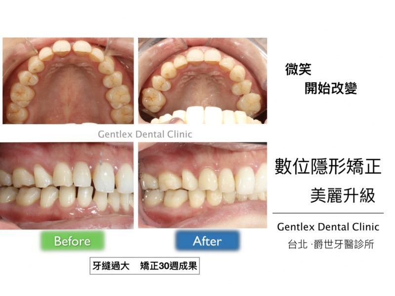 牙縫過大 隱形矯正