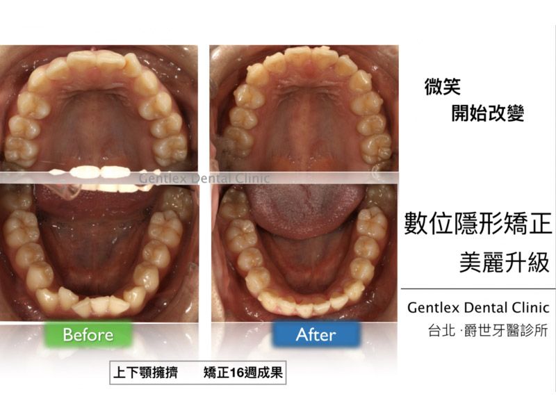 上下顎擁擠 側門牙歪斜