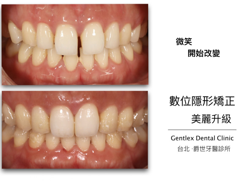 縫隙過大(SPACING)