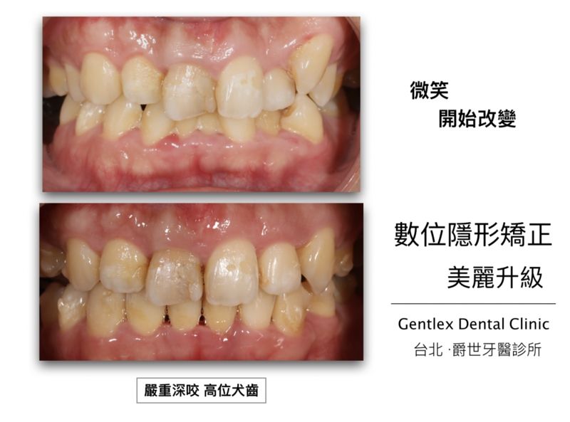 深咬 高位犬齒