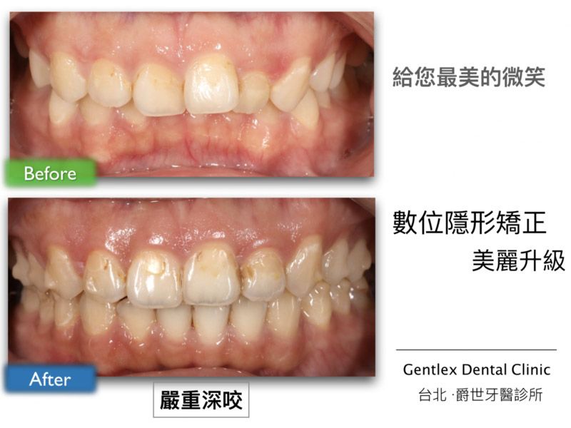 隱形矯正改善深咬