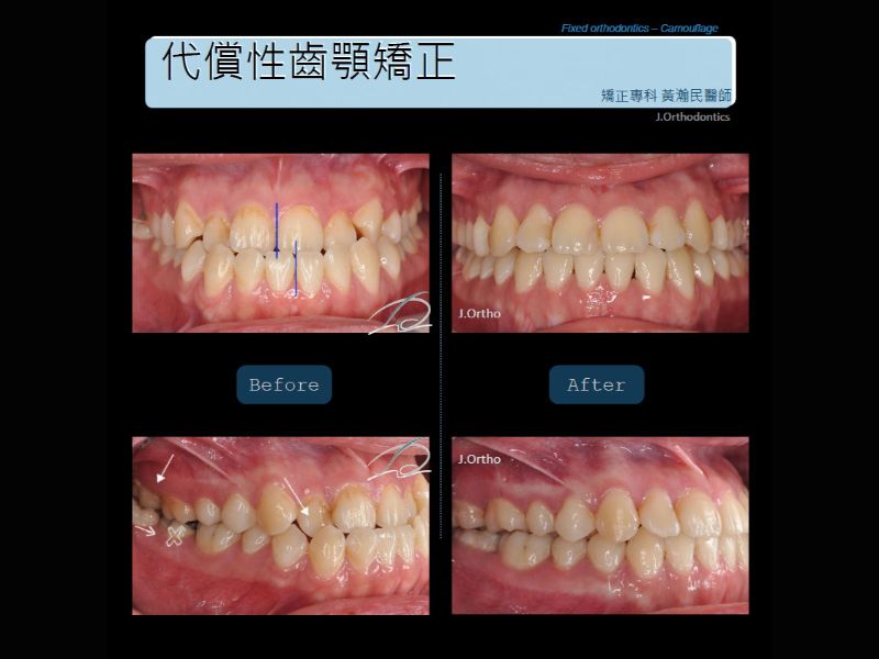 代償性齒顎矯正
