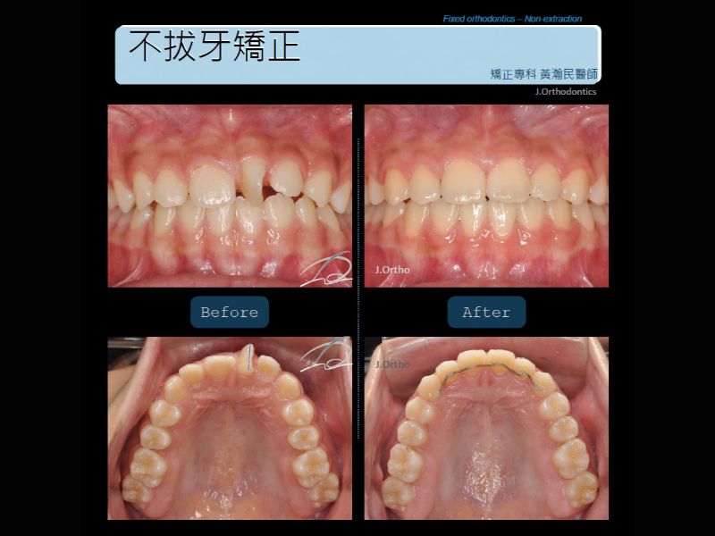 不拔牙矯正