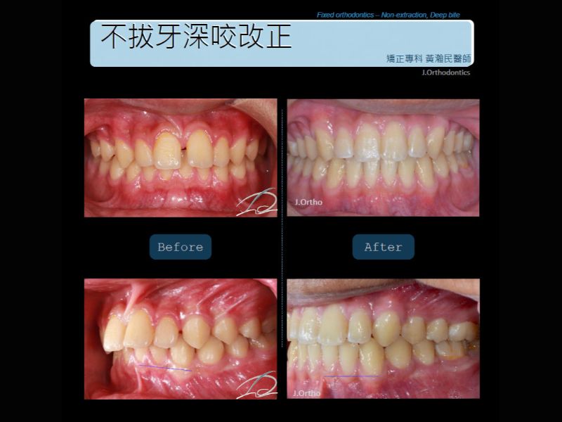 不拔牙深咬改正