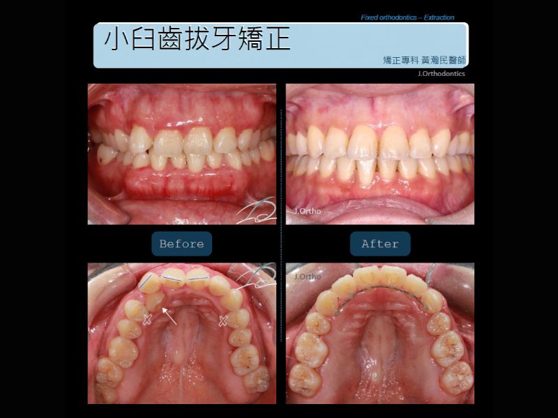 小臼齒拔牙矯正