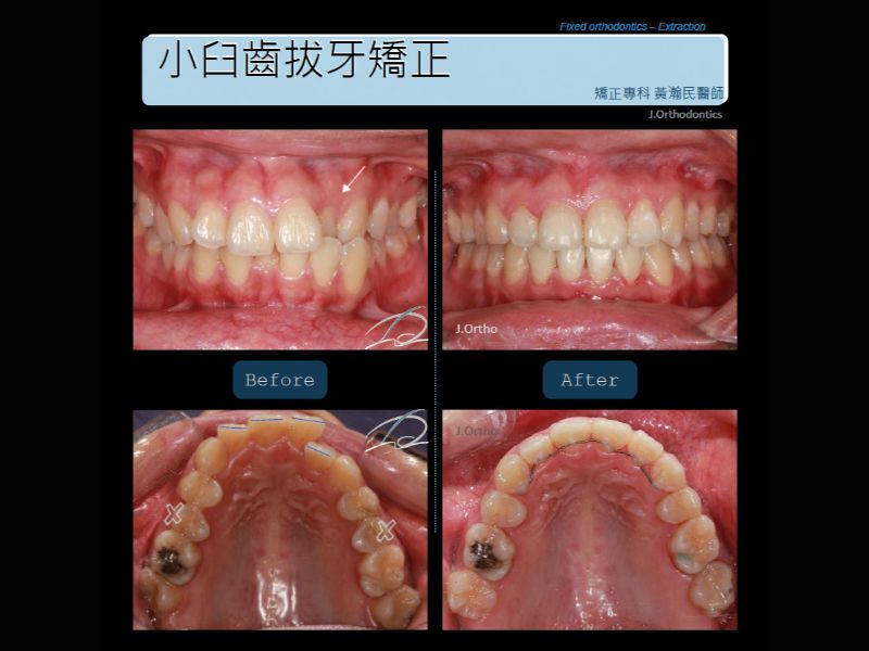 小臼齒拔牙矯正