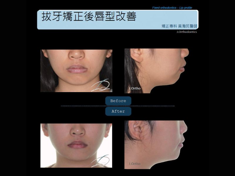 拔牙矯正後唇型改善