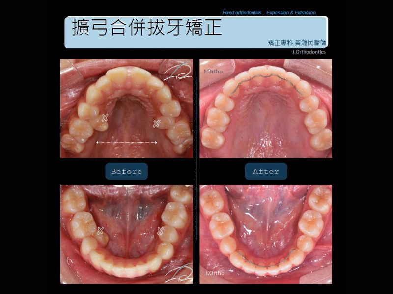 擴弓合併拔牙矯正