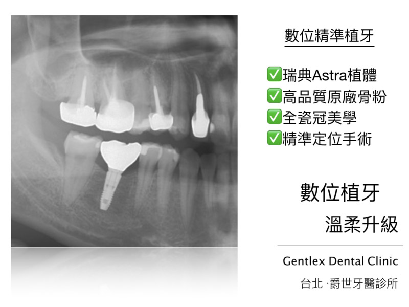 數位植牙 右下第一大臼齒重建