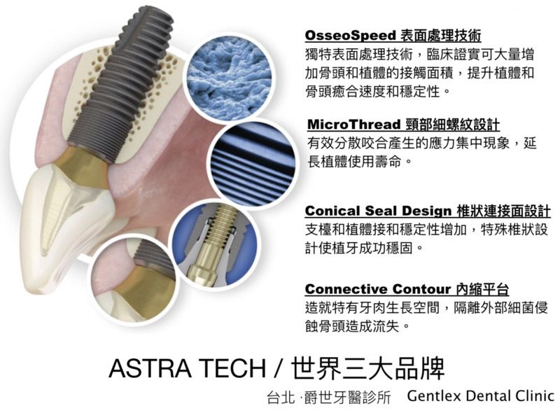 爵世嚴選 ASTRA TECH 植體