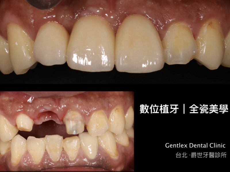 前牙美學 植牙重建