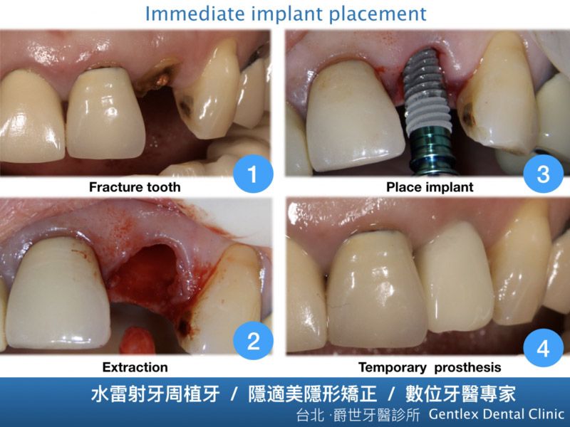 即拔即種 數位植牙