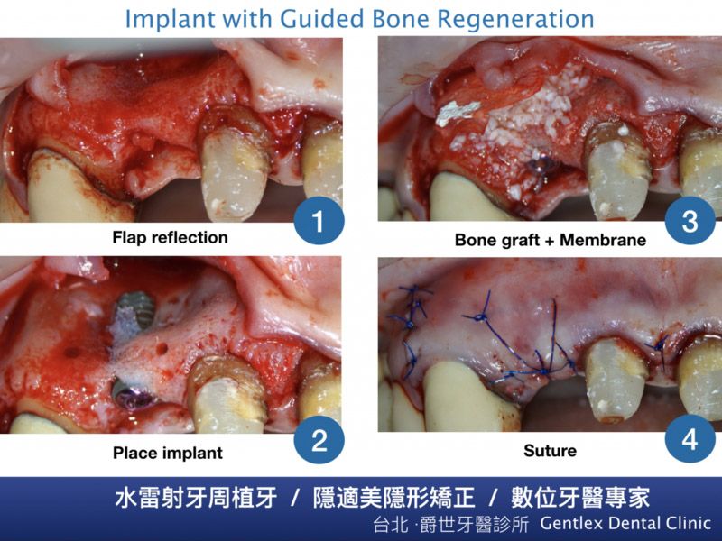 骨缺損人工補骨及再生膜置放