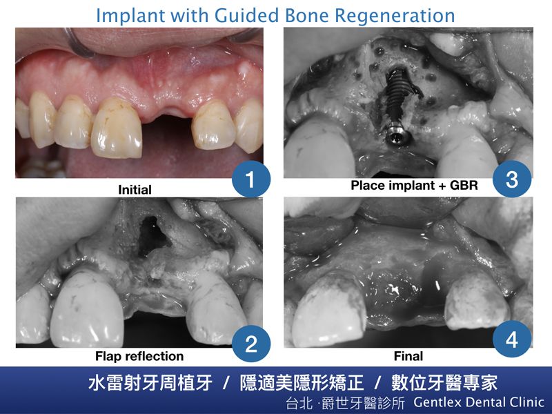 困難前牙植牙補骨