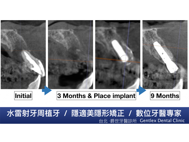 困難大範圍植牙補骨