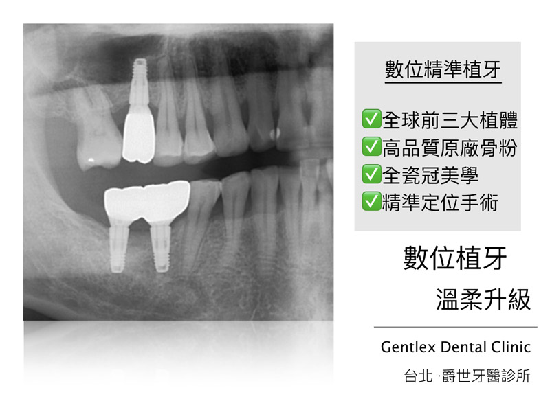 數位精準植牙