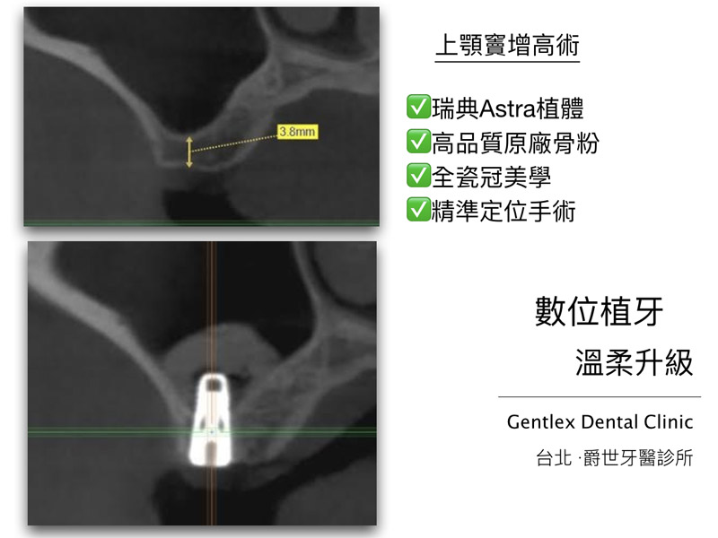 上顎竇增高手術