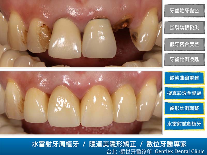 前牙重建，美學再現