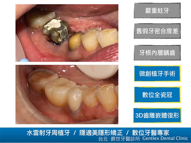 水雷射微創植牙