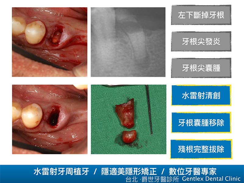 水雷射清創拔牙