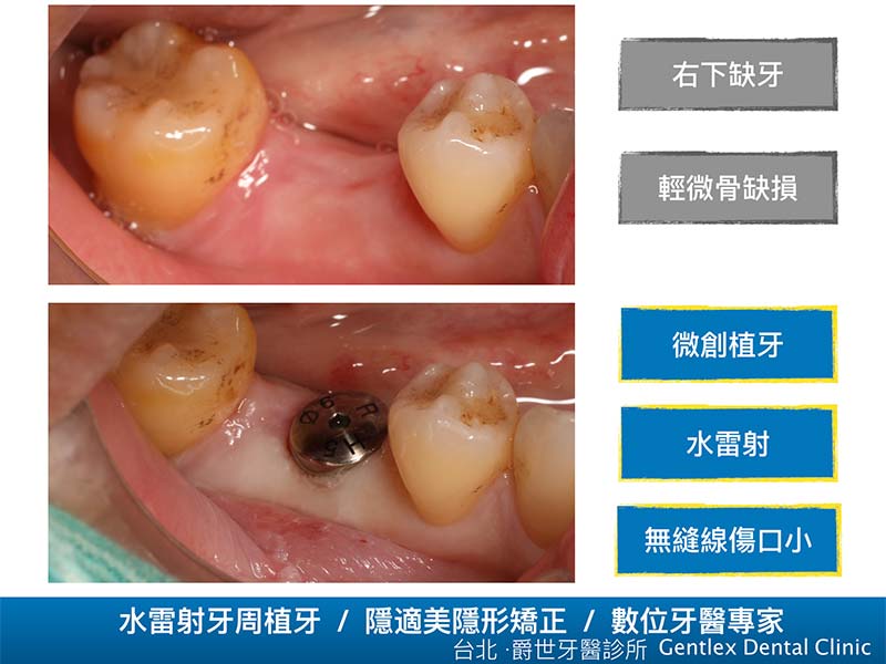 水雷射微創植牙