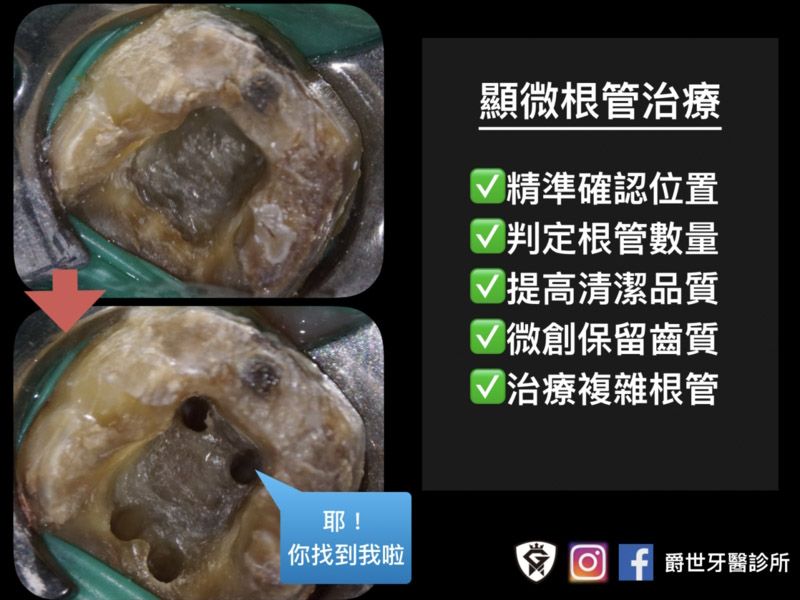 顯微根管治療