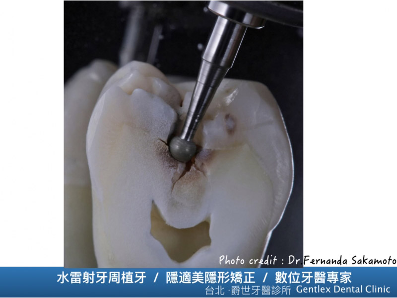 你的蛀牙長什麼樣子？