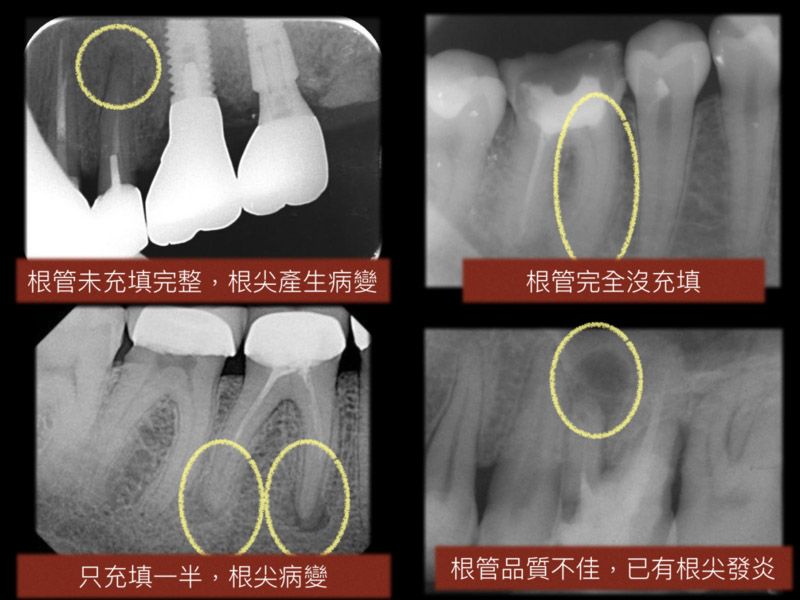 為什麼要根管治療