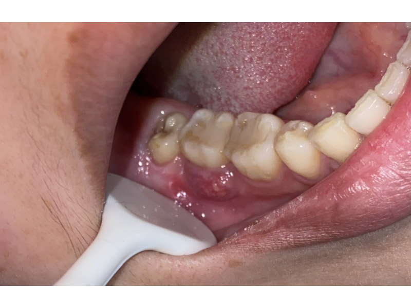 根管發炎牙齦腫脹