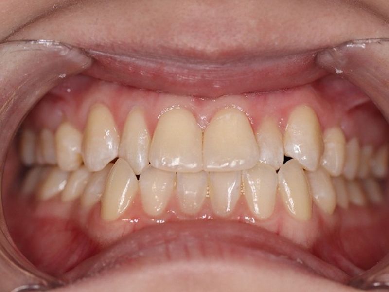 牙科美學關縫：打造自信迷人笑容的關鍵